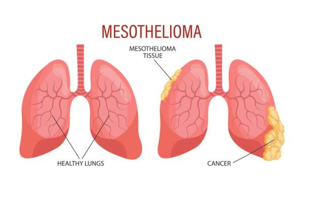 Mesothelioma is an aggressive and rare form of cancer that develops in the thin layer of tissue called the mesothelium, which covers most of the body's internal organs. The most common type of mesothelioma affects the pleura, the lining of the lungs. Imagine two pairs of lungs side by side. On the left, you see a healthy pair of lungs. The tissue is pink and appears smooth, with a clear pleural lining that allows the lungs to expand and contract easily during breathing. The airways are open, and the lungs are free from any visible abnormalities. In contrast, on the right, you see a pair of lungs affected by mesothelioma after asbestos exposure. The once-healthy pleural lining is now thickened and inflamed, with visible whitish or grayish tumors scattered across the surface. These tumors are the result of cancerous cells growing uncontrollably in the mesothelium. As the tumors grow and spread, they begin to press against the lung tissue, causing the lungs to appear compressed and distorted. The airways may be narrowed or obstructed, making it difficult for the person to breathe. Fluid may also accumulate between the pleural layers, a condition known as pleural effusion, further compromising lung function. The cancerous tissue in the mesothelioma-affected lungs has an irregular, bumpy appearance, unlike the smooth surface of the healthy lungs. The tumors may vary in size and shape, ranging from small nodules to larger, more extensive masses. As the disease progresses, the cancer cells can invade nearby structures such as the chest wall, diaphragm, or lymph nodes, further compromising the lungs and overall health. This side-by-side comparison of healthy lungs and those affected by mesothelioma highlights the stark contrast between normal lung tissue and the devastating impact of asbestos exposure on the pleural lining. It is a sobering reminder of the importance of preventing asbestos exposure and the need for early detection and treatment of mesothelioma.