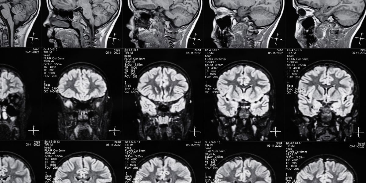 Image of brain injury medical scan. Good to have when fighting a traumatic brain injury case. Call for a free consultant with a brain injury attorney at 1-888-873-8111.